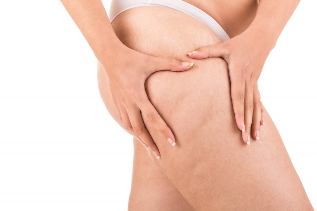 cellulite