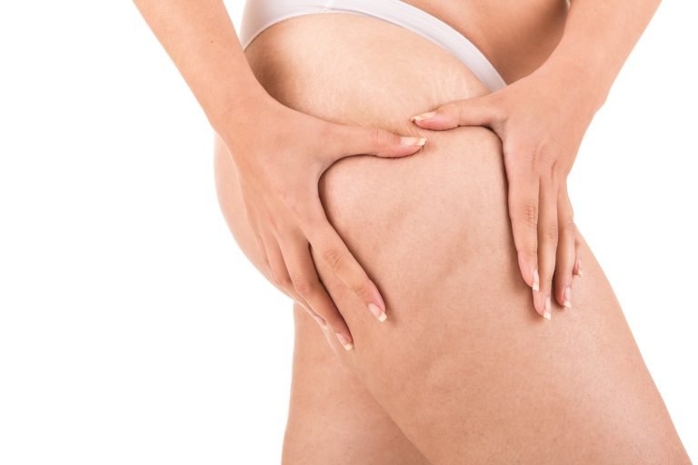 cellulite
